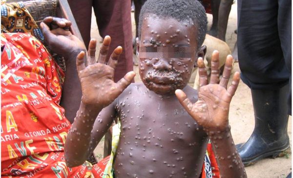 monkeypox1